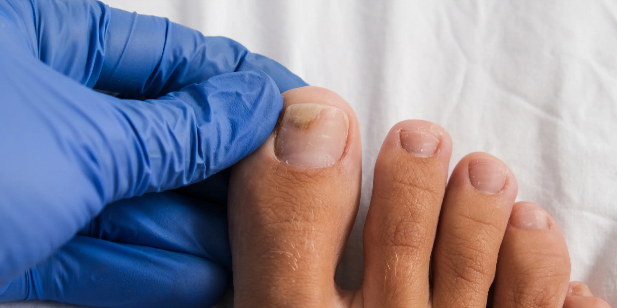découvrez les causes des ongles fendus et explorez les différents traitements pour y remédier. protégez vos ongles tout en leur redonnant éclat et santé grâce à nos conseils et recommandations.